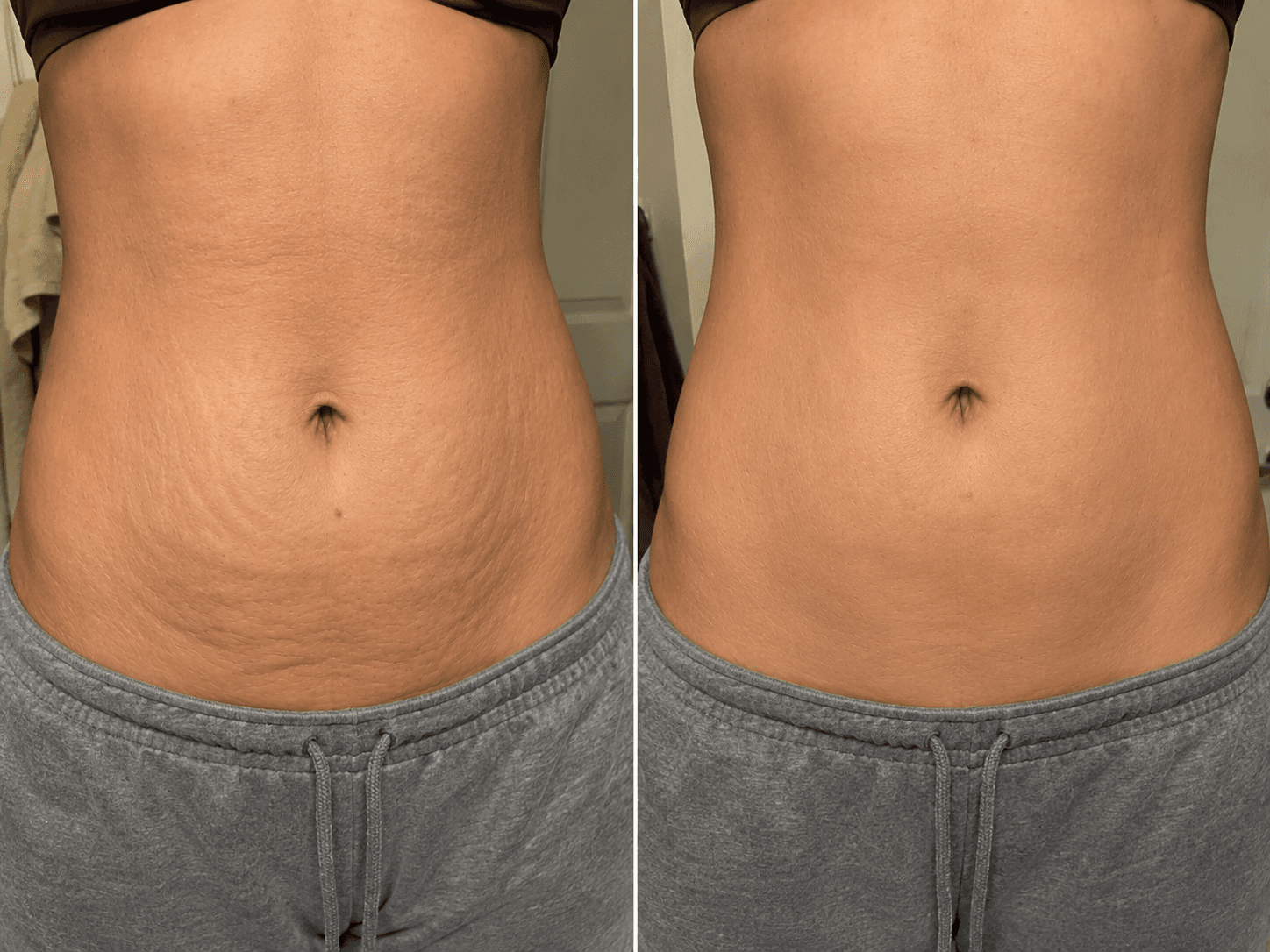 Velora Society before and after result preview